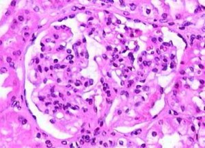 Kidney with IgA. The black is the proteins....