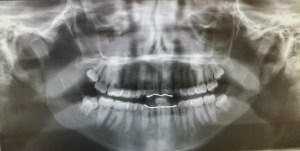 I LOVE x rays. My daughters x ray. 