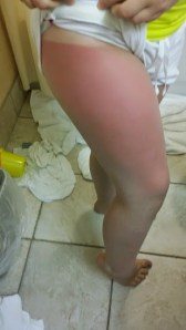 Some seriously angry sun burned skin!